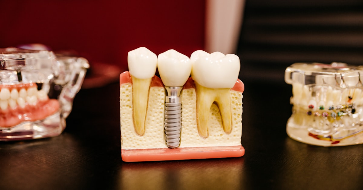 The Importance of Dental Implants